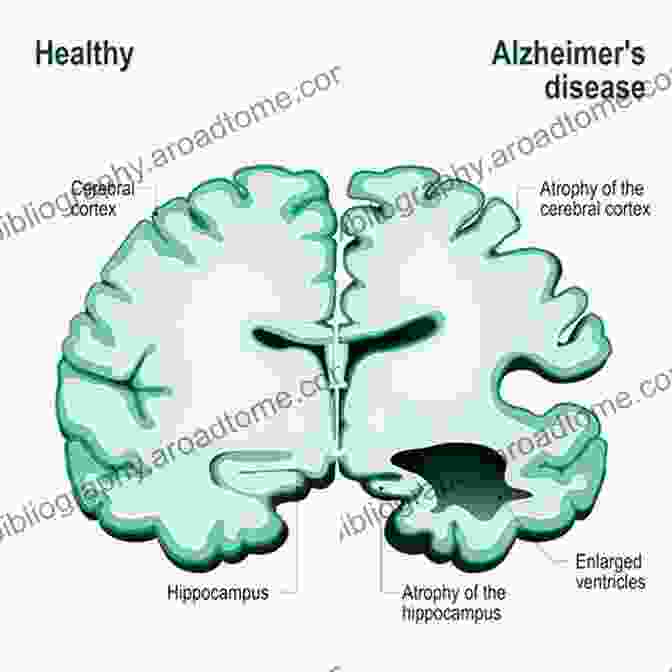 Alzheimer's Disease Brain Restoration Supplements TAKE IT: Proven Supplements That Reverse Alzheimer S Disease