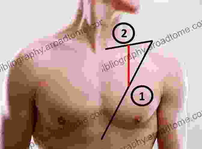 Myocutaneous Flap Demonstrating Skin And Muscle Transfer For Reconstruction Flaps In Plastic And Reconstructive Surgery