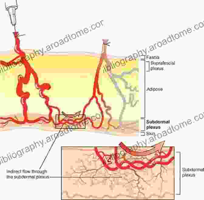 Perforator Flap Highlighting The Targeted Blood Vessel Connection For Tissue Transfer Flaps In Plastic And Reconstructive Surgery