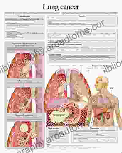 Lung Cancer E Chart: Full Illustrated